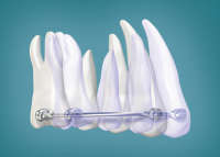 Carriere Motion Class II Appliance